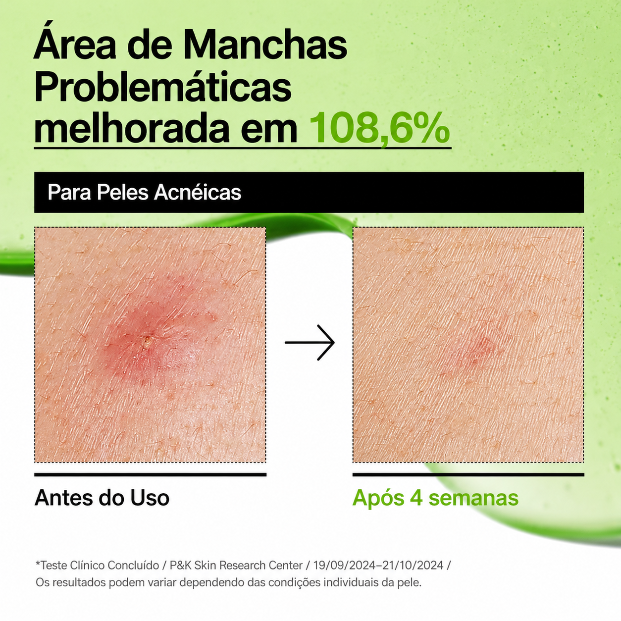 Sérum Ácido Hialurônico Anua Azelaico 10 | Pele Sensivel